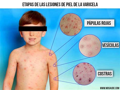 Fotografía de un niño con erupción cutánea típica de varicela, mostrando vesículas y pústulas.