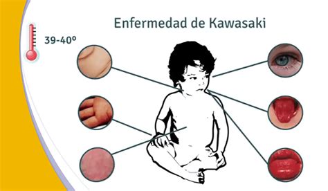 Gráfico de incidencia de la Enfermedad de Kawasaki por edad y estación