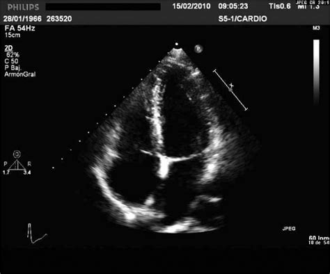 Imagen de ecocardiograma mostrando aneurisma coronario