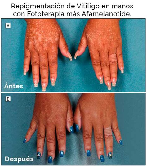 gráfico de resultados de repigmentación en pacientes con vitiligo