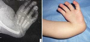 Fotografía clínica de mano con deficiencia de rayos radiales