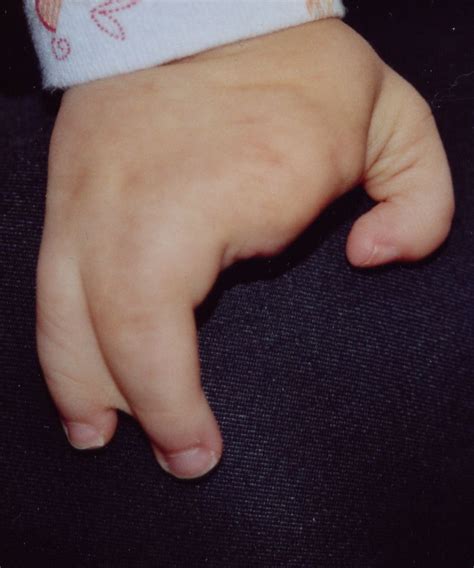 Fotografía de un bebé con mano hendida (ectrodactilia)