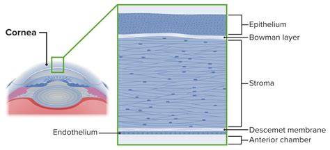 Esquema de la anatomía corneal y las capas que se ven afectadas en las opacidades congénitas (epitelio, estroma, membrana de Descemet y endotelio).