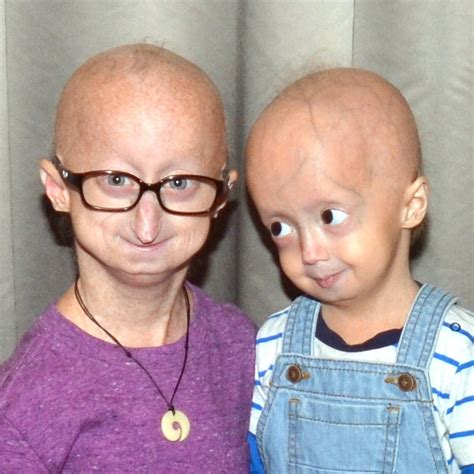 Foto comparativa de un niño con progeria y un niño de la misma edad sin la condición, destacando las diferencias fenotípicas