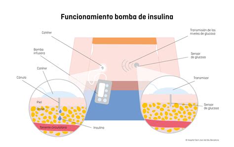 Esquema de una bomba de insulina con catéter y puntos de aplicación