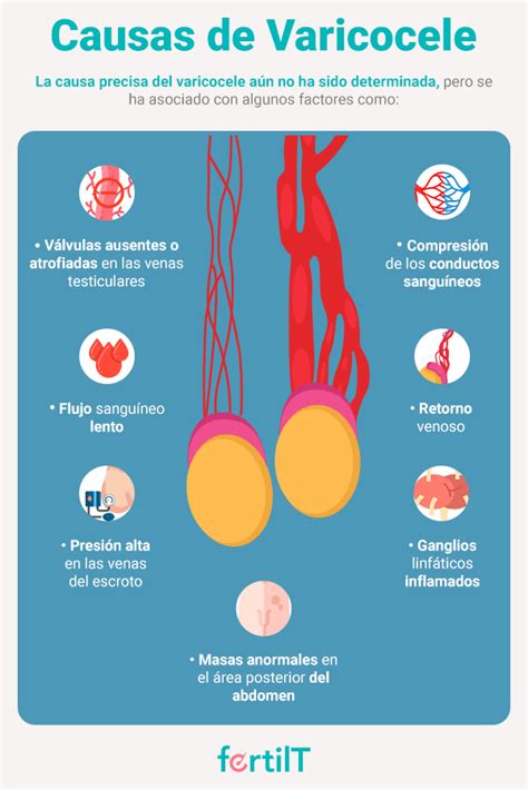 Diagrama mostrando un varicocele en los testículos