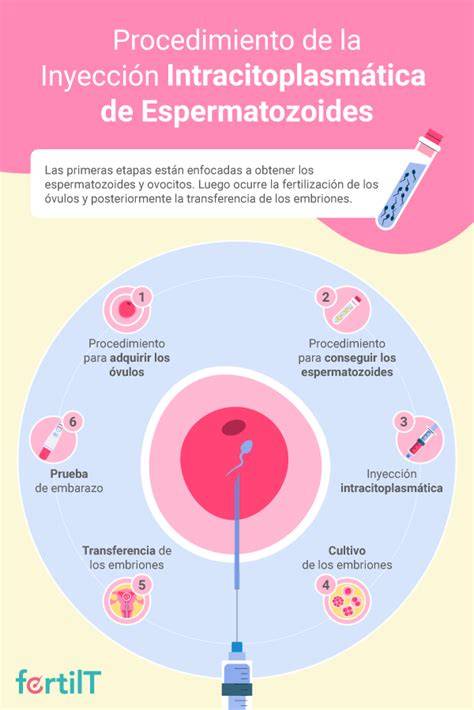 Ilustración de la técnica de Inyección Intracitoplasmática de Espermatozoides (ICSI)