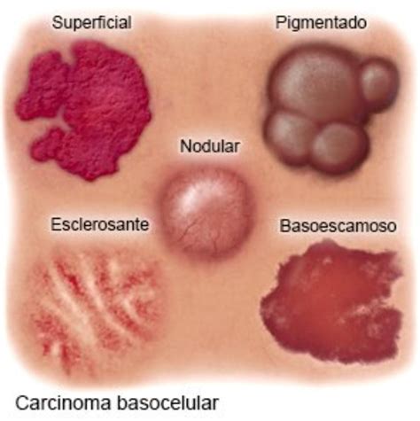 Collage de imágenes mostrando las diferentes apariencias del carcinoma basocelular: nodular, superficial, morfeiforme y pigmentado.
