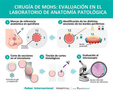 Diagrama comparativo de diferentes técnicas quirúrgicas para el tratamiento del carcinoma basocelular, destacando la cirugía de Mohs.