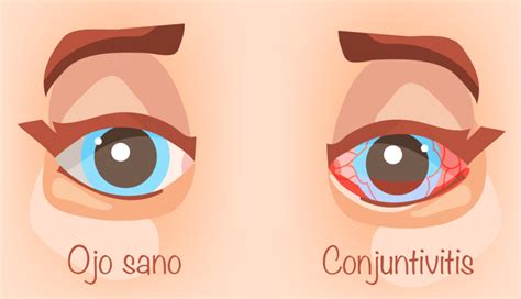 Ilustración o foto de un ojo infantil con conjuntivitis y luego sano.