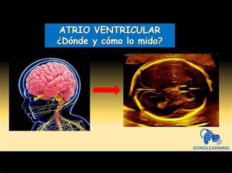 Ilustración de un corte ecográfico cerebral fetal mostrando la medición del atrio ventricular