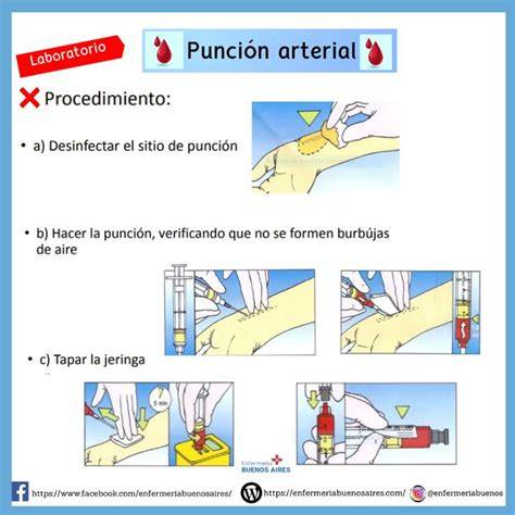 Esquema del procedimiento de punción arterial para la obtención de gases en sangre