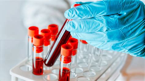 Infografía mostrando las diferentes técnicas de toma de muestras durante una broncoscopia (LBA, biopsia, cepillado).