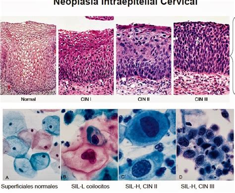 Imagen de los diferentes grados de neoplasia intraepitelial cervical (NIC 1, NIC 2, NIC 3)