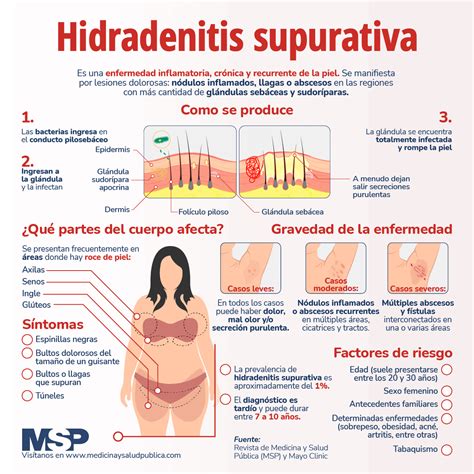 Esquema de las áreas corporales más afectadas por la hidradenitis supurativa, mostrando axilas, ingles, glúteos y debajo de los senos.
