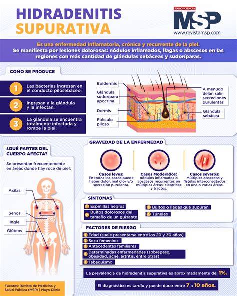 Ilustración de las diferentes lesiones de la hidradenitis supurativa: nódulos dolorosos, abscesos, fístulas y cicatrices 