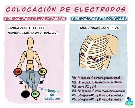 Esquema de las posiciones anterolateral y anteroposterior para la colocación de electrodos de desfibrilación en niños