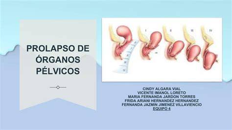 Ilustración anatómica del prolapso de órganos pélvicos