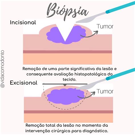 Esquema detallado de biopsia corial con abordaje abdominal y transcervical