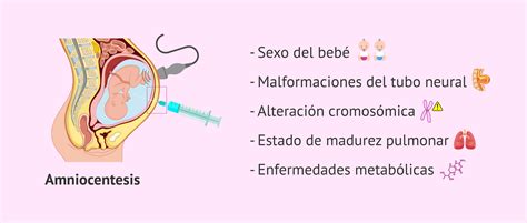 Ilustración clara de amniocentesis mediante punción del abdomen materno