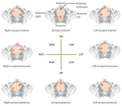 Diagrama que muestra la posición occipitoanterior (izquierda) y la posición occipitoposterior (derecha) del feto.