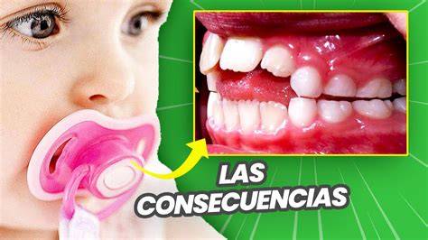 Infografía mostrando las deformaciones dentales causadas por el chupete
