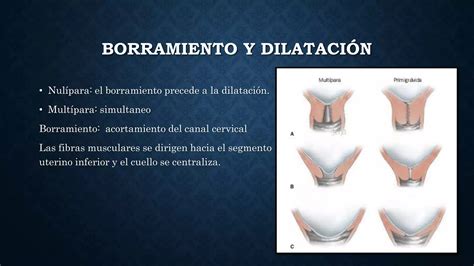 infografía mostrando los cambios en el cuello uterino: borramiento y dilatación