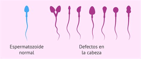 Infografía sobre los diferentes tipos de deformaciones en los espermatozoides (cabeza, cuello, cola)