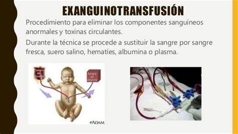 Esquema de exanguinotransfusión neonatal