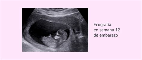 Ecografía de un feto de 12 semanas mostrando el desarrollo general