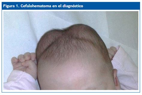 Imagen de un recién nacido con cefalohematoma bilateral.