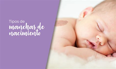 Comparación visual de diferentes tipos de marcas de nacimiento vasculares.