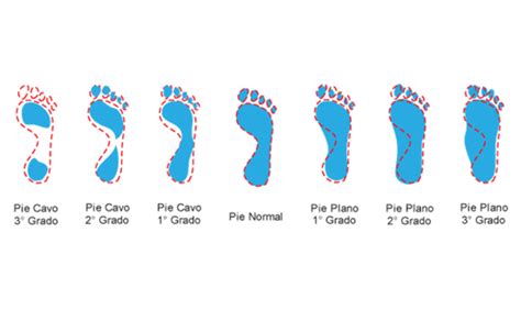 Huella plantar en podoscopio mostrando diferentes grados de pie plano
