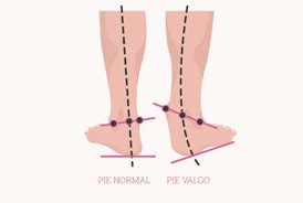Diagrama de flujo del manejo diagnóstico-terapéutico del pie plano valgo infantil