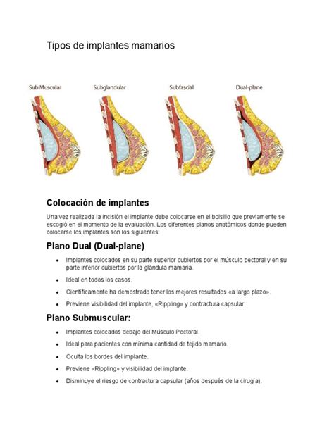 Esquema de las diferentes colocaciones de implantes mamarios (subglandular, submuscular)