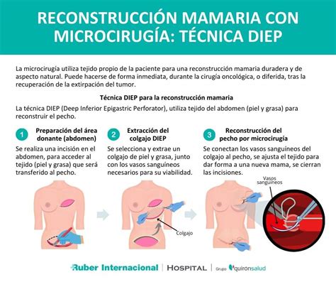 Infografía: Impacto de la cirugía de reducción mamaria en los conductos galactóforos