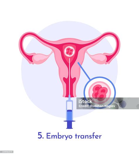 Ilustración de la transferencia embrionaria guiada por ecografía