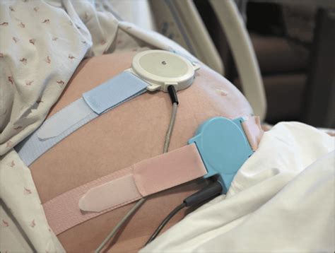 Ilustración de la monitorización fetal interna con electrodo en el cuero cabelludo fetal