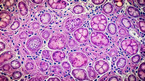 Micrografía de tejido hepático dañado por toxicosis de hierro
