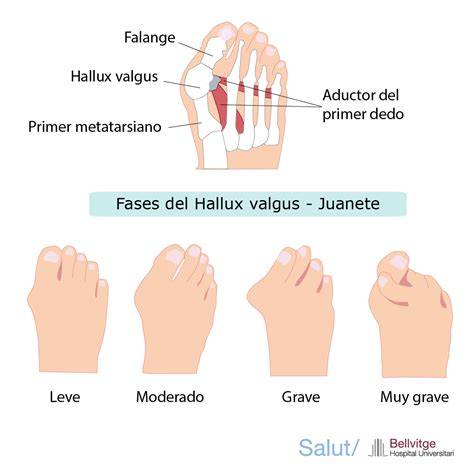 Esquema o diagrama detallado del corrector de hallux valgus pediátrico, mostrando la férula y los puntos de ajuste