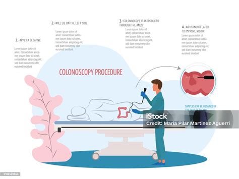 Esquema del procedimiento de colonoscopia mostrando el colonoscopio y la visualización del intestino