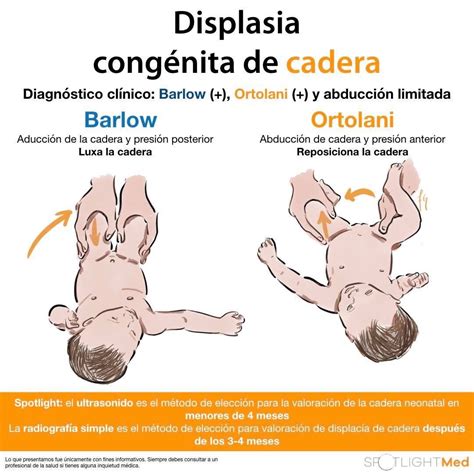 Ilustración de las maniobras de Ortolani y Barlow para la detección de displasia de cadera.