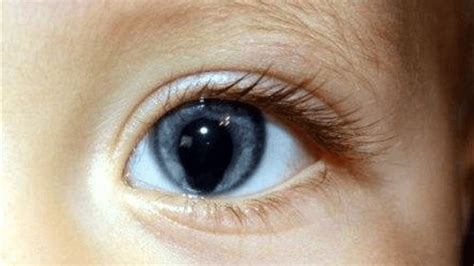 Infografía: Causas genéticas y ambientales del coloboma