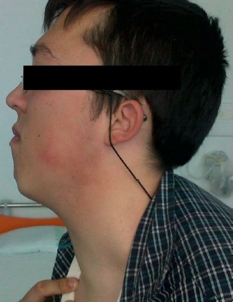 Múltiples lesiones papilomatosas coalescentes que cubren el área cervical de los dientes