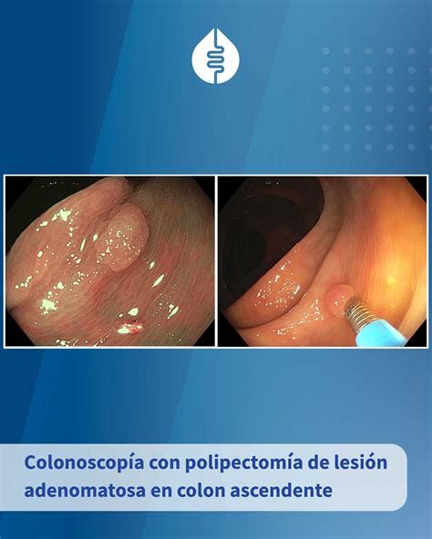 Hamartoma de colon descendente en paciente con síndrome de Cowden observado en colonoscopia