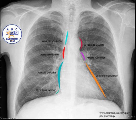 Radiografía de tórax de un neonato destacando la silueta cardíaca y el mediastino