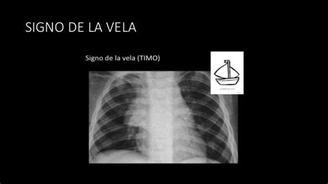 Radiografía de tórax de un neonato mostrando el característico signo de la vela tímica