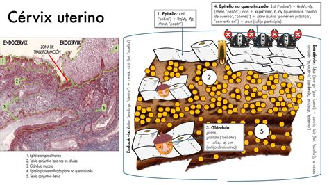Esquema del útero y cérvix, mostrando las áreas de posible displasia y el procedimiento de colposcopia.