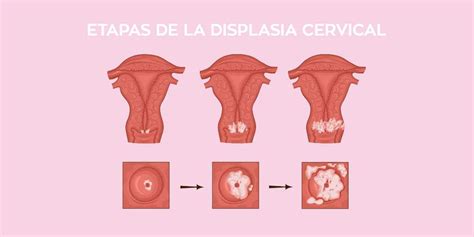 Ilustración de los diferentes tratamientos para la displasia cervical: criocirugía, láser, conización.