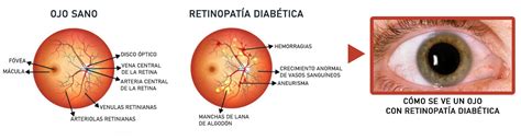 Diagrama de los vasos sanguíneos de la retina afectados por la diabetes